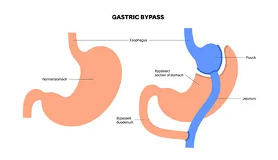 بای پس معده