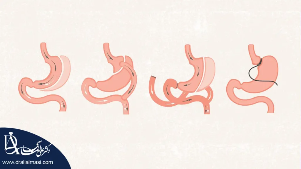 عمل لاغری شاخص