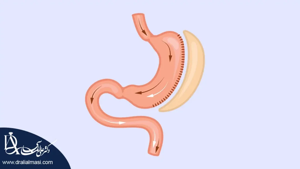 عمل اسلیو معده شاخص