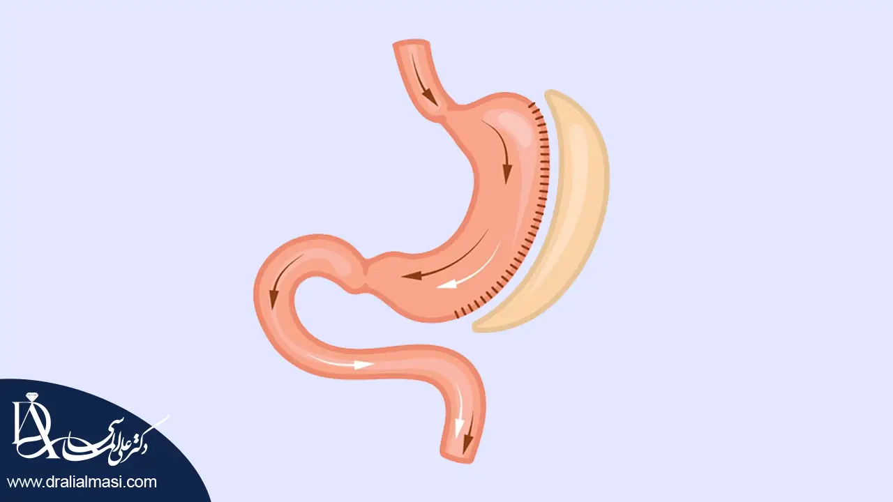 عمل اسلیو معده شاخص