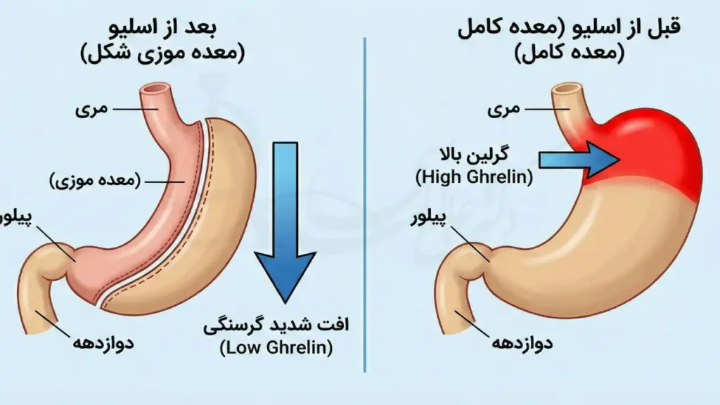 تاثیر عمل اسلیو معده بر حذف فوندوس و کاهش هورمون گرلین