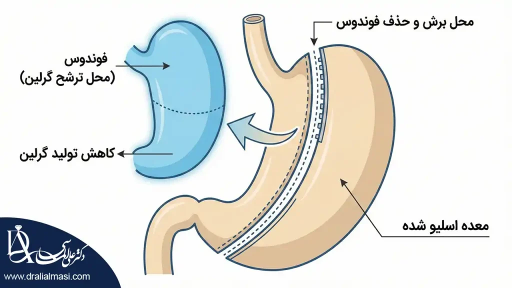 تصویر اینفوگرافیک که نشان دهنده نحوه عمل اسلیو معده و برداشتن قسمت ترشح کننده هورمون گرلین است